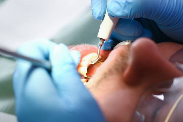 Best Emergency Tooth Extraction in Canutillo, TX